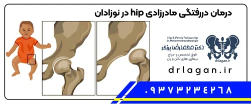 بیماری دیسپلازی هیپ و درمان دررفتگی مادرزادی hip در کودکان