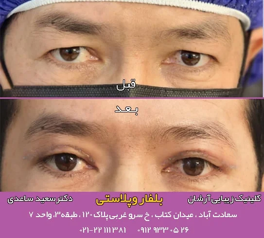 انواع جراحی زیبایی پلک یا بلفاروپلاستی + سن مناسب برای بلفاروپلاستی
