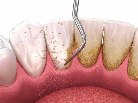 از کف بندی دندان چه می دانید؟