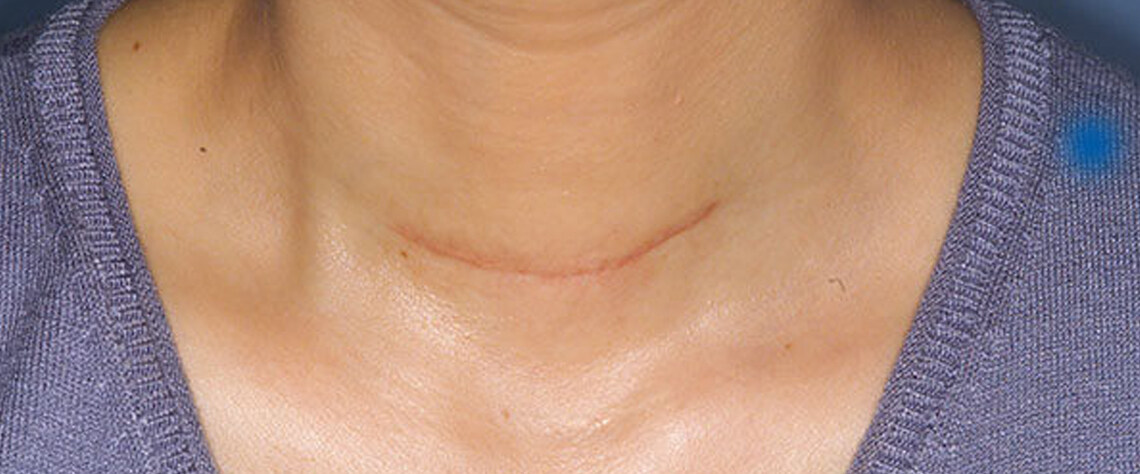 چکاپ کامل بعد از جراحی تیروئید با پزشک متخصص انتخاب مراکز معتبر برای چکاپ پس از جراحی تیروئید